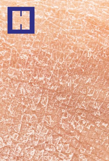 Psoriasis y otras enfermedades inflamatorias