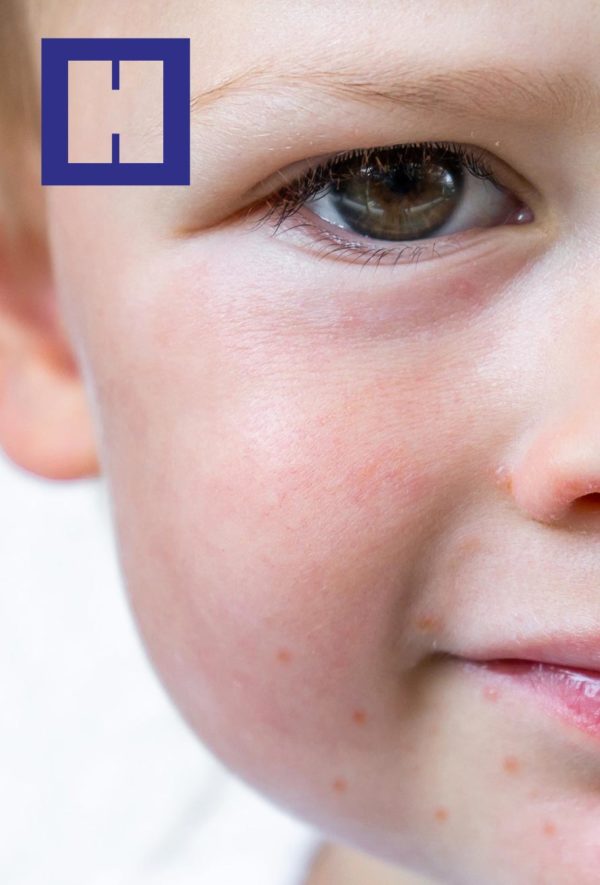 Dermatología Pediátrica