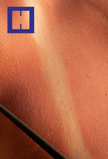 Fotodermatosis y fotobiología