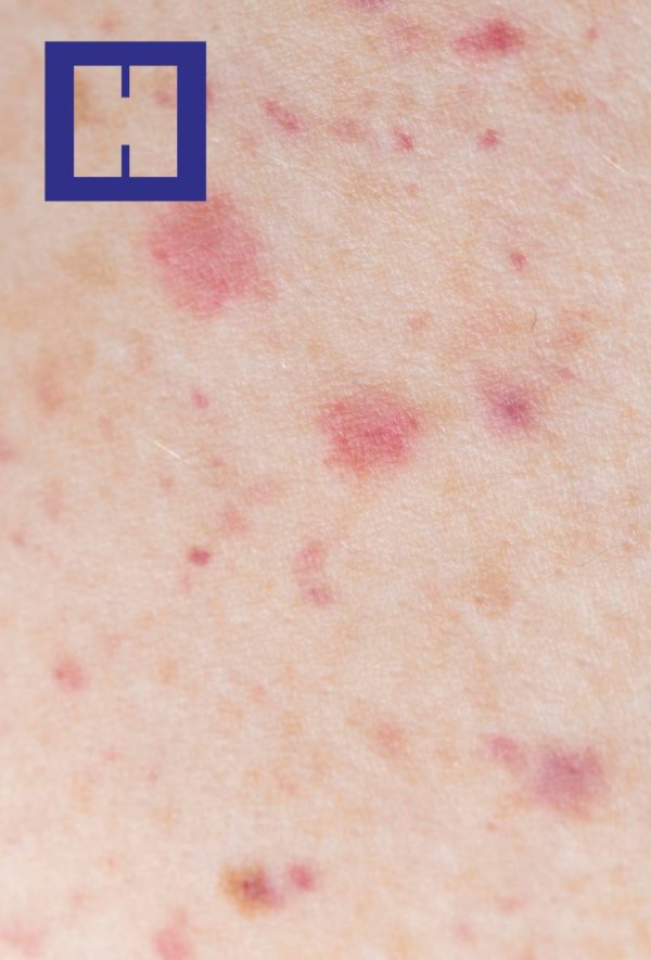 Hidradenitis Supurativa