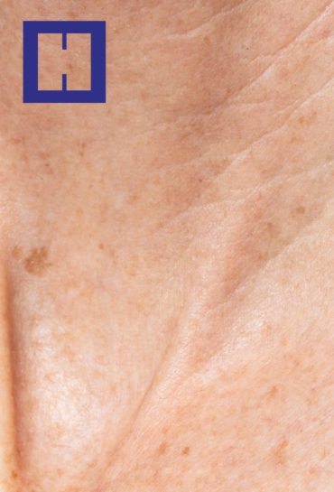 Dermatitis atópica e Inmunoalergia Cutánea