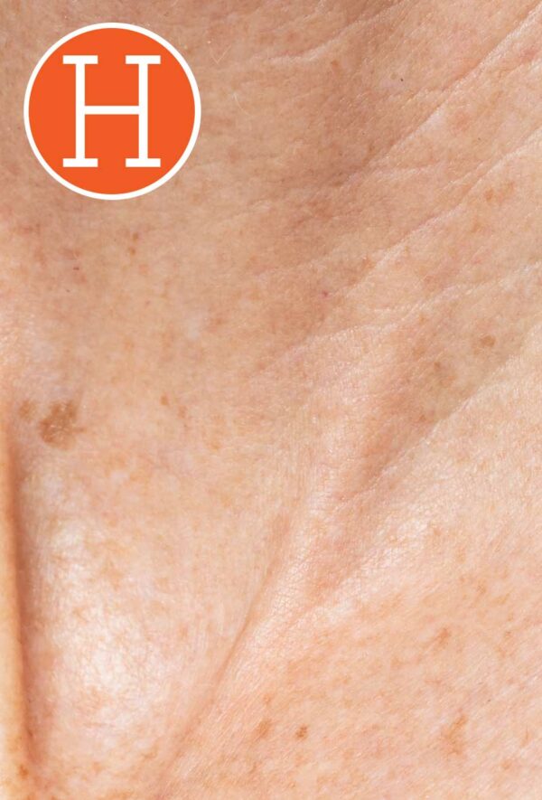 Dermatitis atópica e Inmunoalergia Cutánea