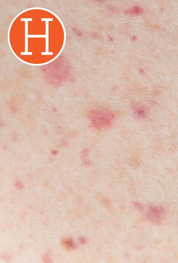 Hidradenitis Supurativa